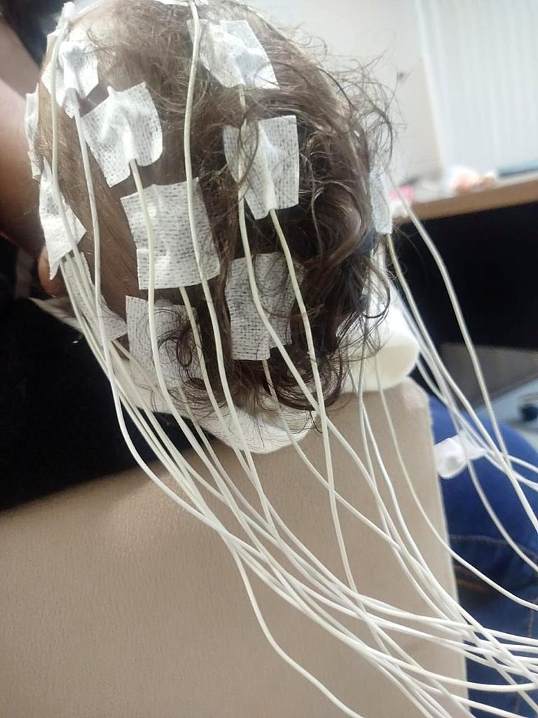 Eletrodos posicionados no couro cabeludo para exame de EEG